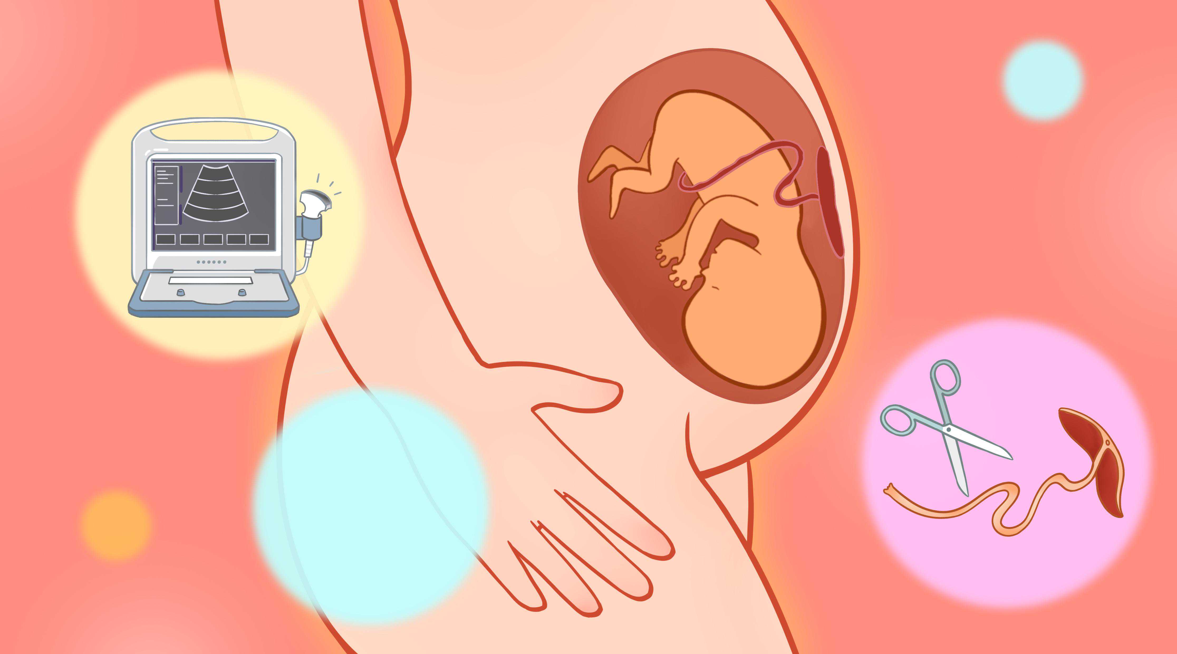 如何解读子宫动脉血流报告？